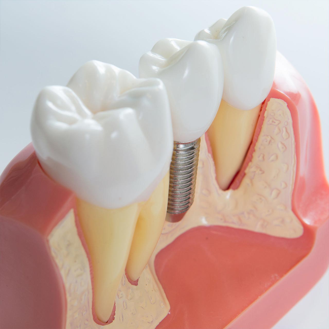 implantación de dientes